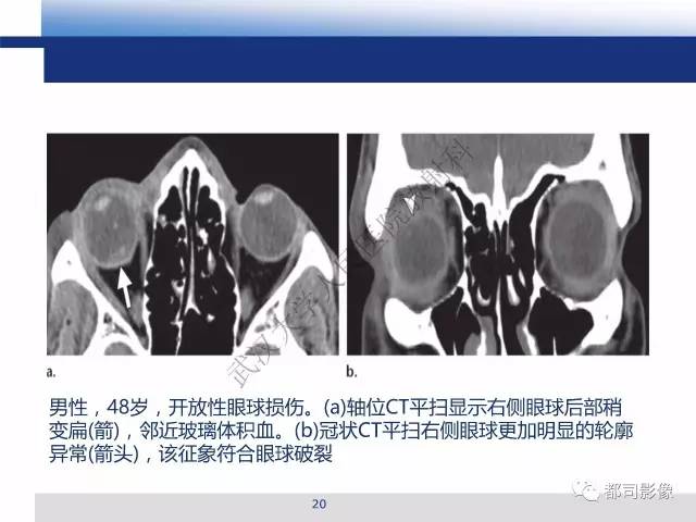 【PPT】眼球损伤影像诊断