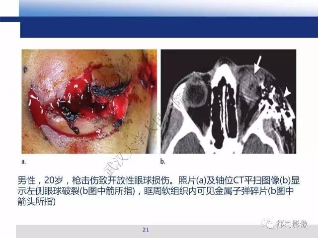 【PPT】眼球损伤影像诊断