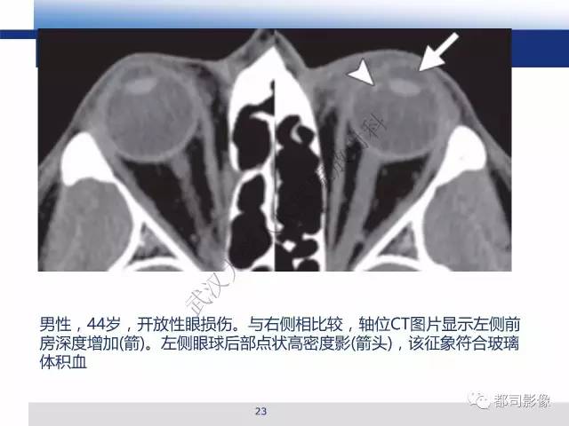 【PPT】眼球损伤影像诊断