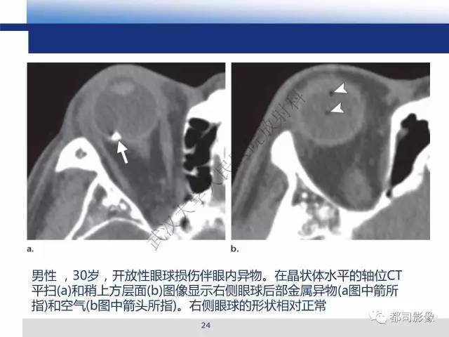 【PPT】眼球损伤影像诊断