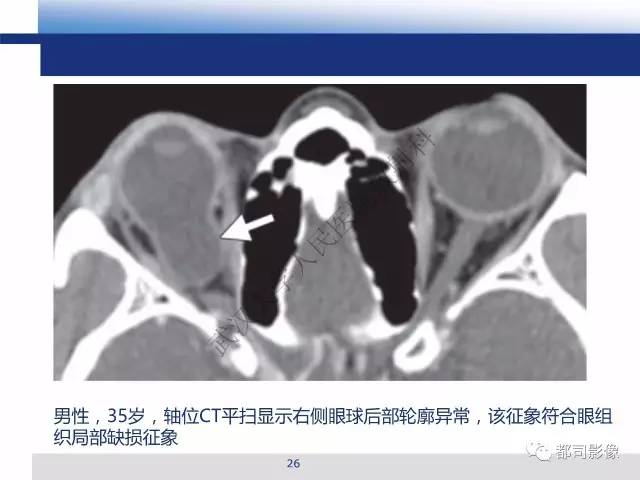 【PPT】眼球损伤影像诊断