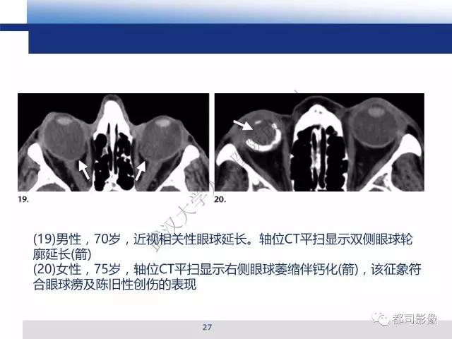 【PPT】眼球损伤影像诊断