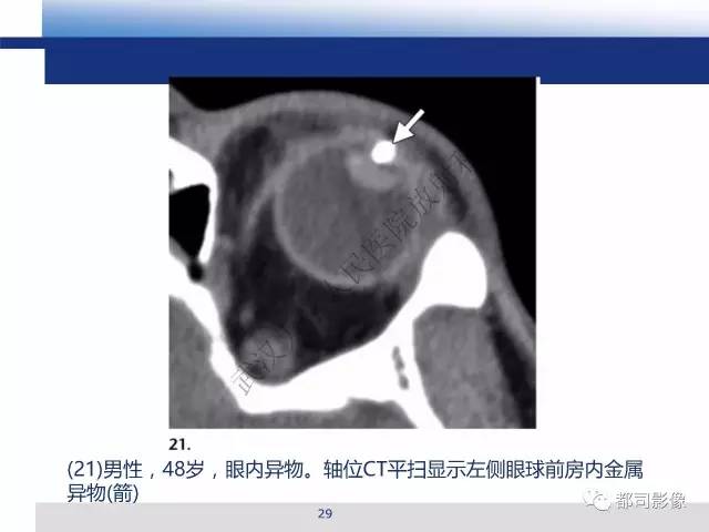【PPT】眼球损伤影像诊断