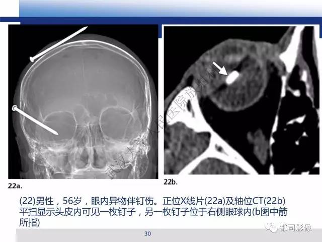 【PPT】眼球损伤影像诊断