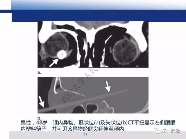 【PPT】眼球损伤影像诊断