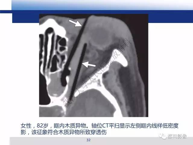 【PPT】眼球损伤影像诊断