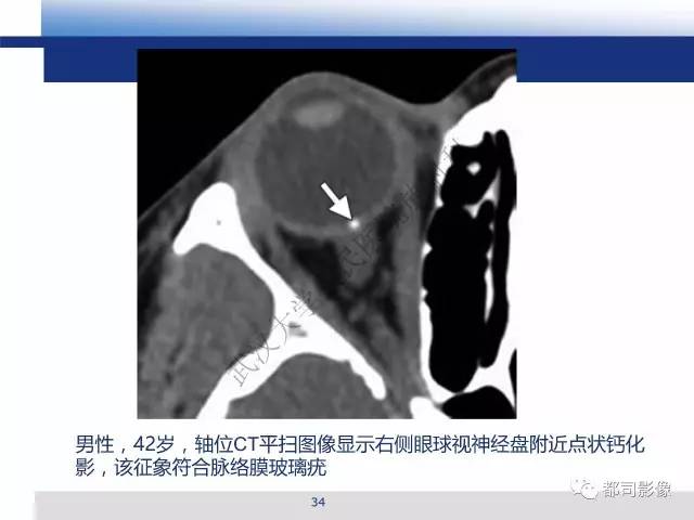 【PPT】眼球损伤影像诊断