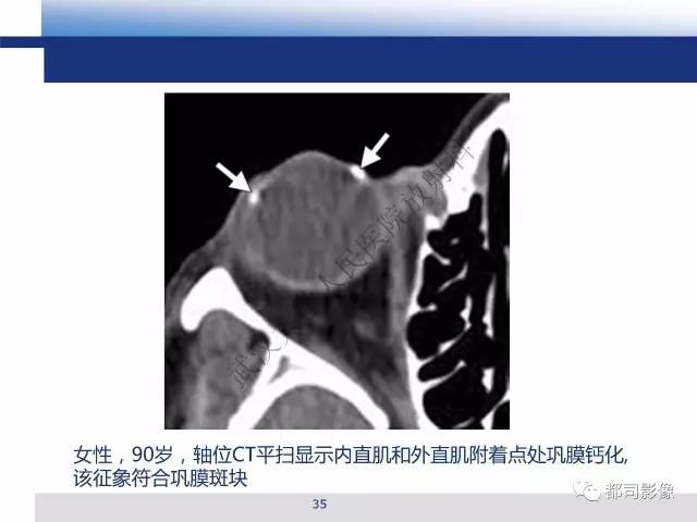 【PPT】眼球损伤影像诊断