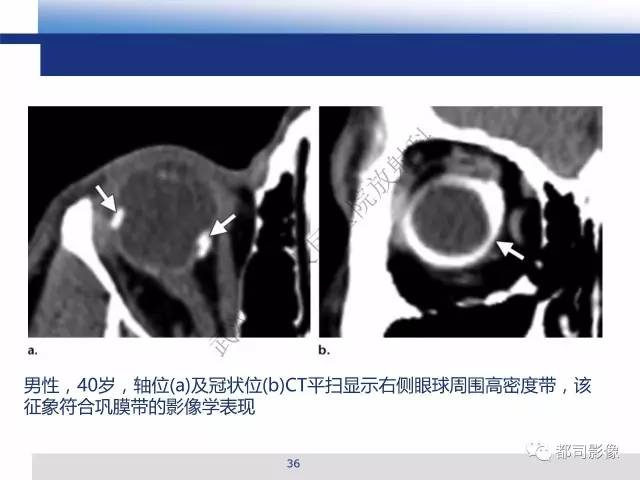 【PPT】眼球损伤影像诊断