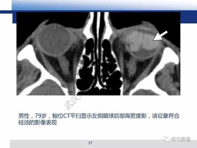 【PPT】眼球损伤影像诊断