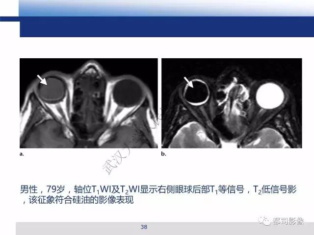 【PPT】眼球损伤影像诊断