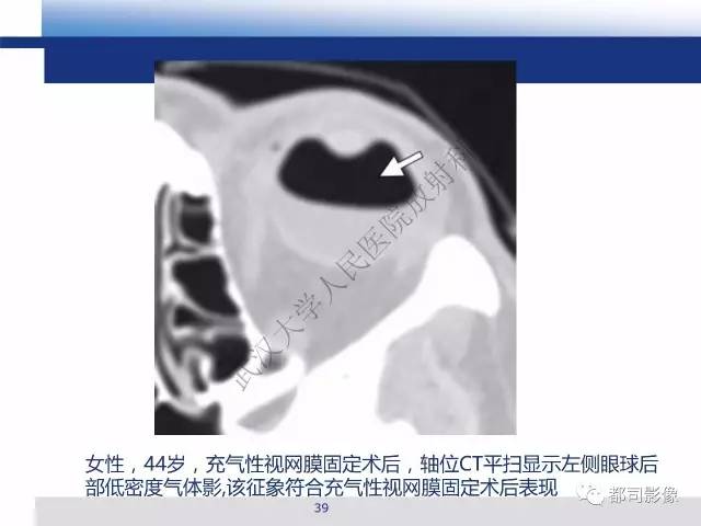 【PPT】眼球损伤影像诊断
