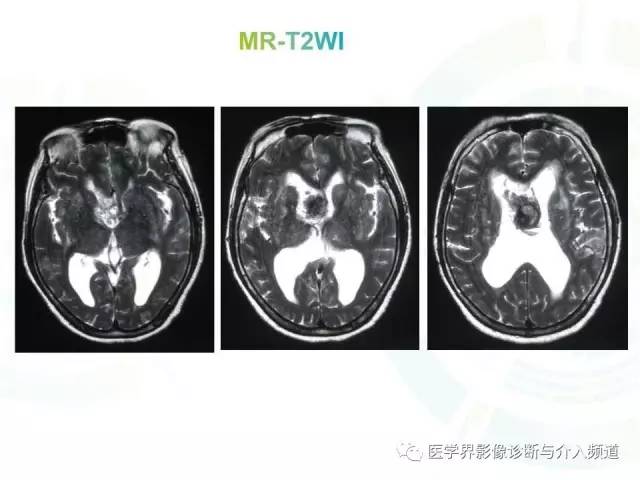 【病例】脑室内海绵状血管瘤1例