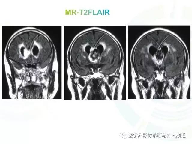 【病例】脑室内海绵状血管瘤1例