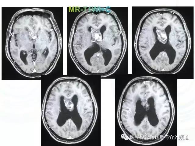 【病例】脑室内海绵状血管瘤1例
