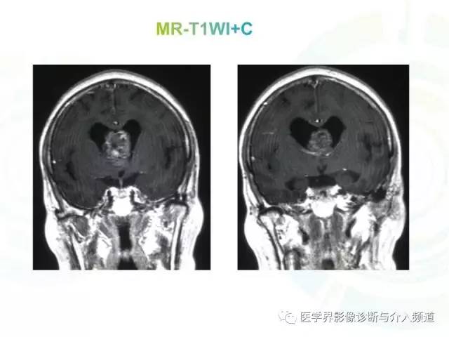 【病例】脑室内海绵状血管瘤1例