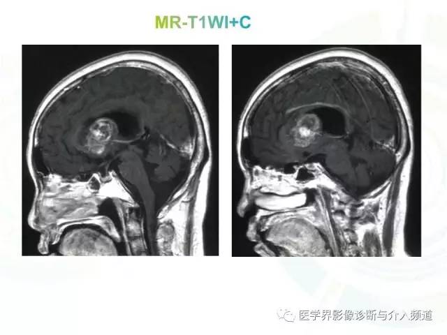 【病例】脑室内海绵状血管瘤1例