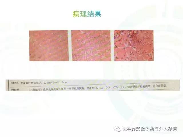 【病例】脑室内海绵状血管瘤1例