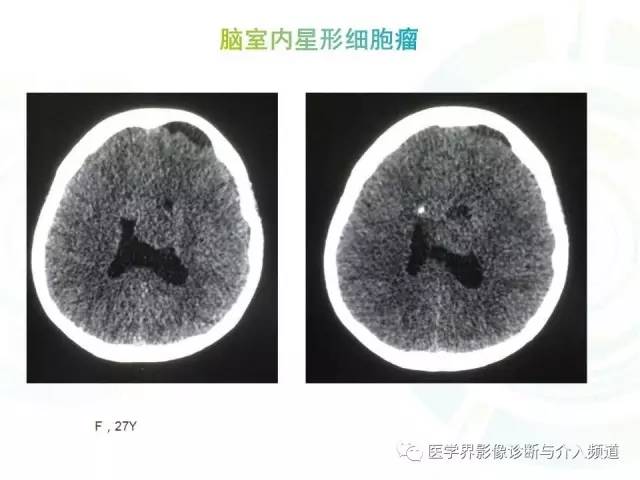 【病例】脑室内海绵状血管瘤1例