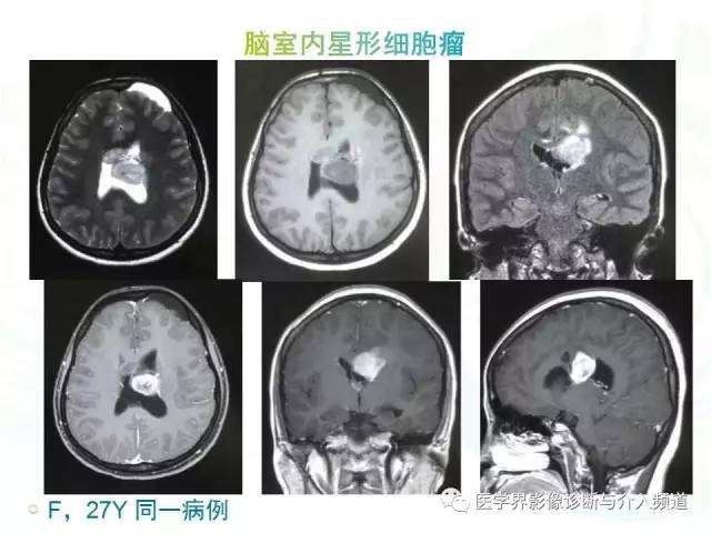 【病例】脑室内海绵状血管瘤1例