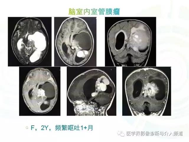 【病例】脑室内海绵状血管瘤1例