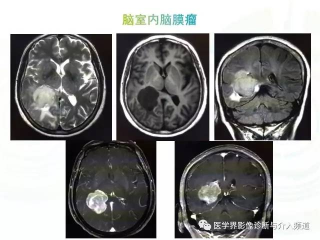 【病例】脑室内海绵状血管瘤1例