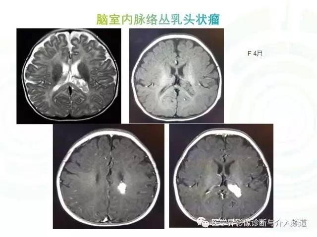【病例】脑室内海绵状血管瘤1例