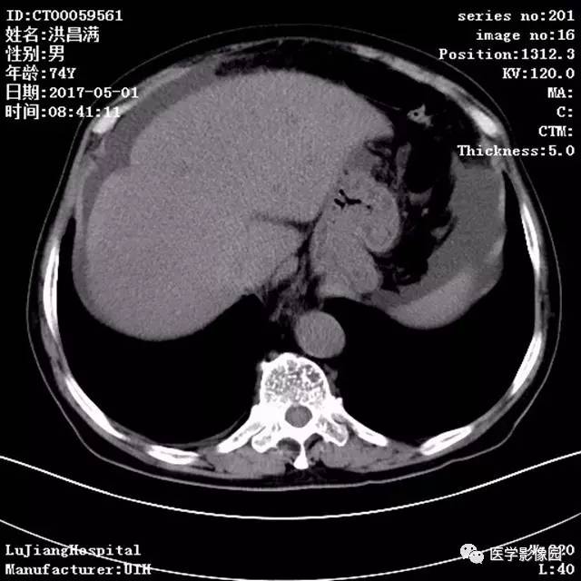 【病例】肝小静脉闭塞症1例CT影像表现