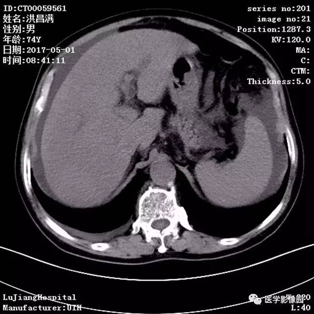 【病例】肝小静脉闭塞症1例CT影像表现 【病例】肝小静脉闭塞症1例CT影像表现
