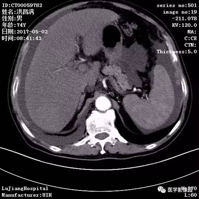 【病例】肝小静脉闭塞症1例CT影像表现 【病例】肝小静脉闭塞症1例CT影像表现