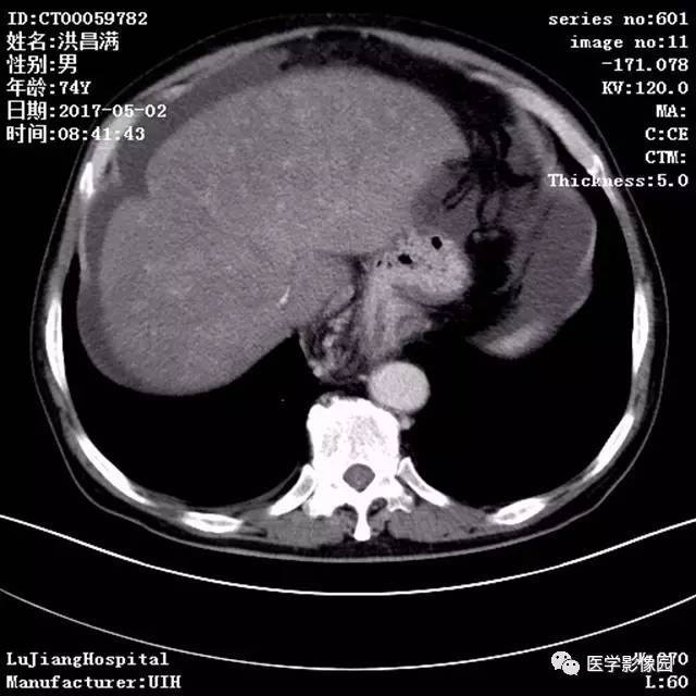 【病例】肝小静脉闭塞症1例CT影像表现 【病例】肝小静脉闭塞症1例CT影像表现