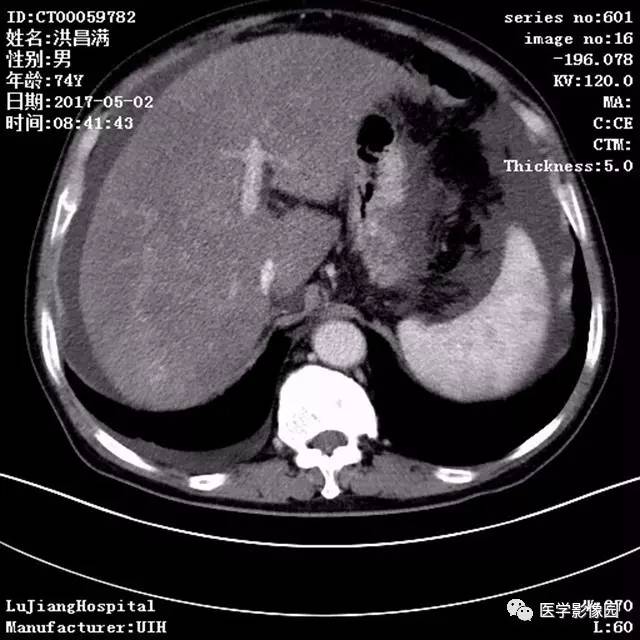 【病例】肝小静脉闭塞症1例CT影像表现 【病例】肝小静脉闭塞症1例CT影像表现