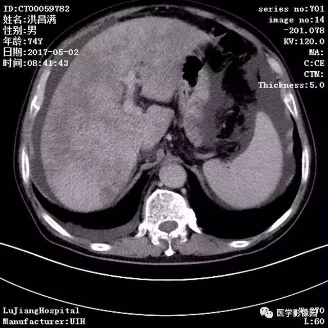 【病例】肝小静脉闭塞症1例CT影像表现