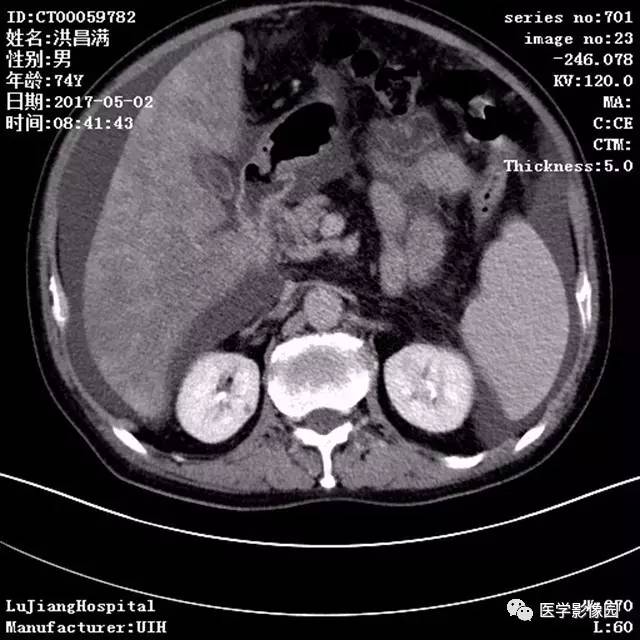 【病例】肝小静脉闭塞症1例CT影像表现 【病例】肝小静脉闭塞症1例CT影像表现