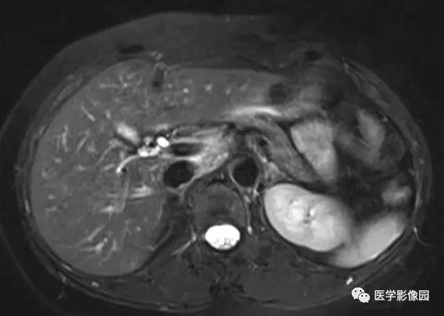 【病例】肝上皮样血管平滑肌脂肪瘤1例MR影像表现 【病例】肝上皮样血管平滑肌脂肪瘤1例MR影像表现