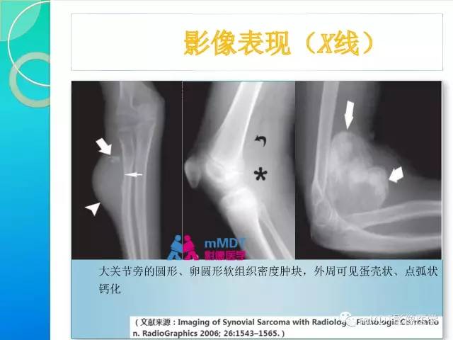 【PPT】滑膜肉瘤的影像诊断