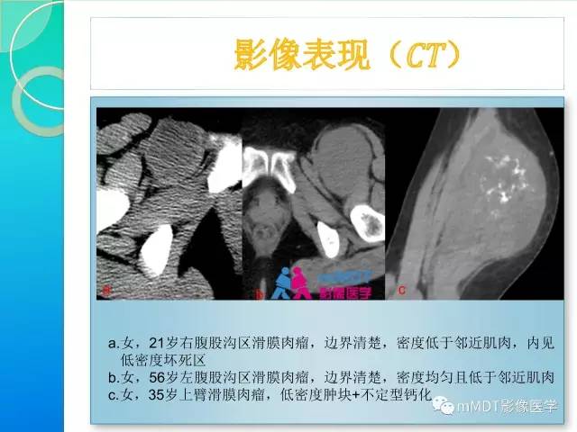 【PPT】滑膜肉瘤的影像诊断