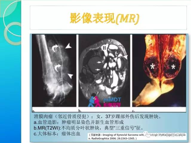 【PPT】滑膜肉瘤的影像诊断