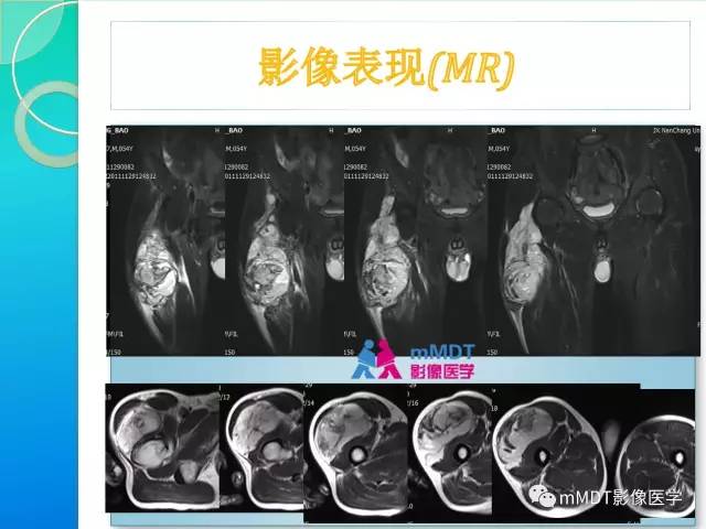 【PPT】滑膜肉瘤的影像诊断
