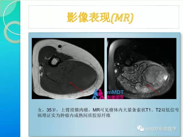 【PPT】滑膜肉瘤的影像诊断