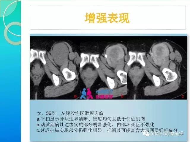 【PPT】滑膜肉瘤的影像诊断