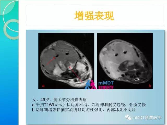 【PPT】滑膜肉瘤的影像诊断