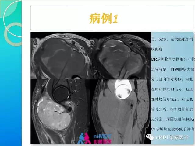 【PPT】滑膜肉瘤的影像诊断