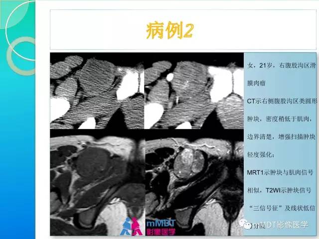【PPT】滑膜肉瘤的影像诊断