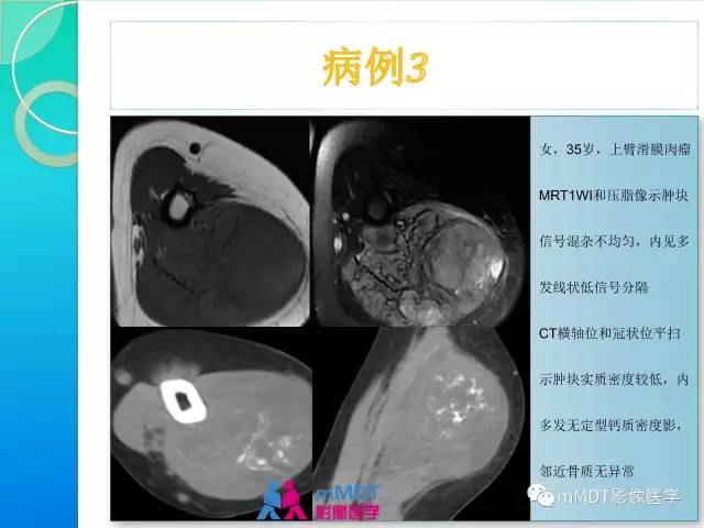 【PPT】滑膜肉瘤的影像诊断