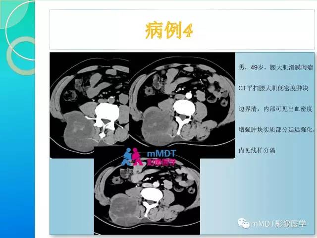 【PPT】滑膜肉瘤的影像诊断