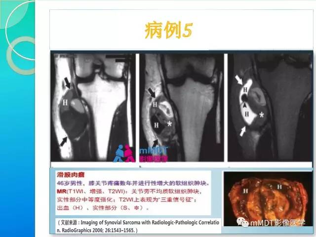 【PPT】滑膜肉瘤的影像诊断