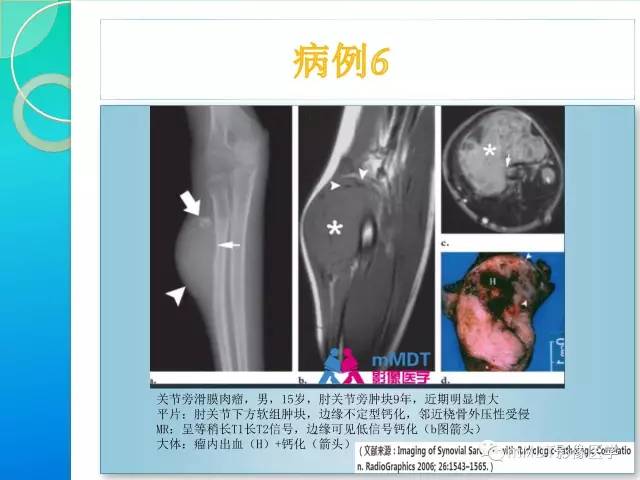 【PPT】滑膜肉瘤的影像诊断