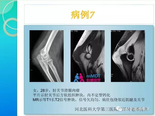 【PPT】滑膜肉瘤的影像诊断