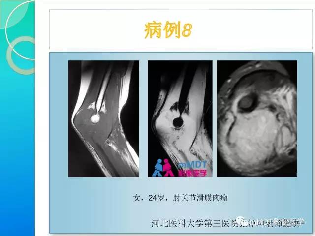 【PPT】滑膜肉瘤的影像诊断